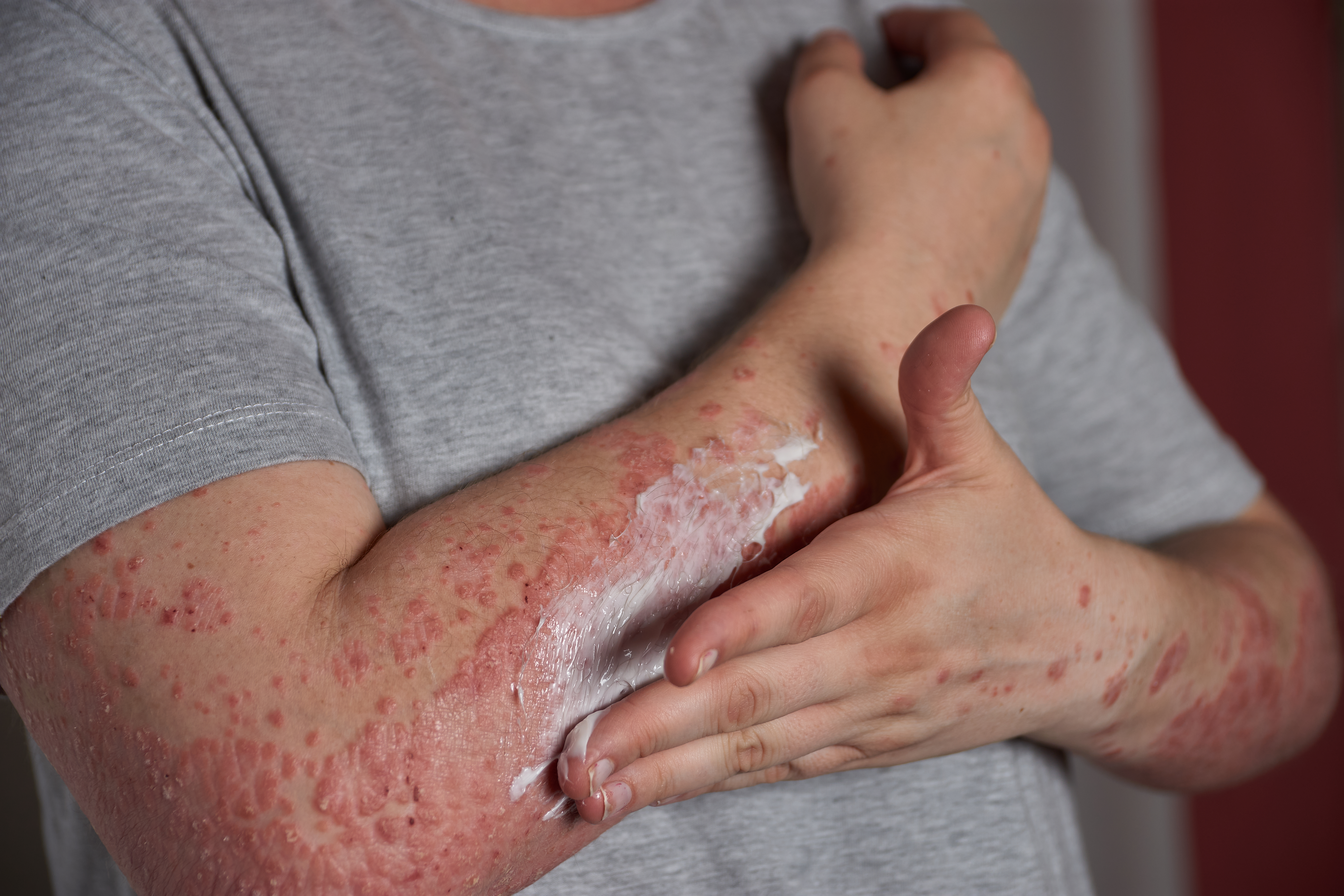 Guttate Psoriasis